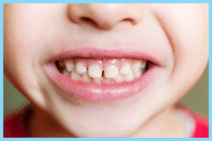 Child Development: Biting